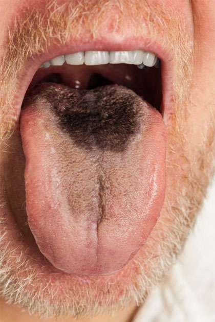 Tongue1